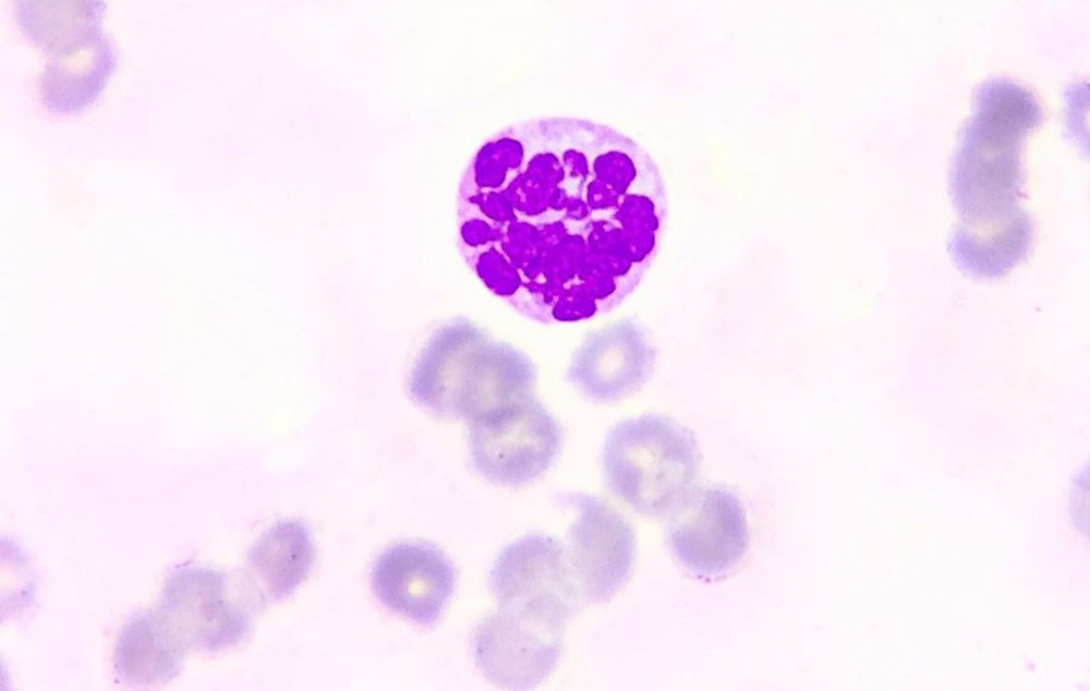 megaloblastna_anemija